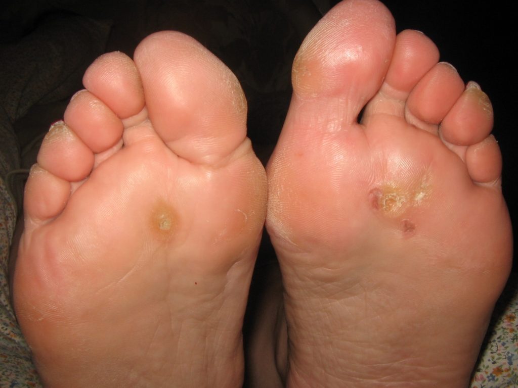 foot warts pain treatment