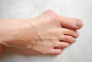 bunion correction surgery before