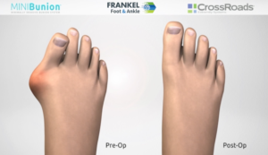 illustration of frankel faststep bunion procedure results