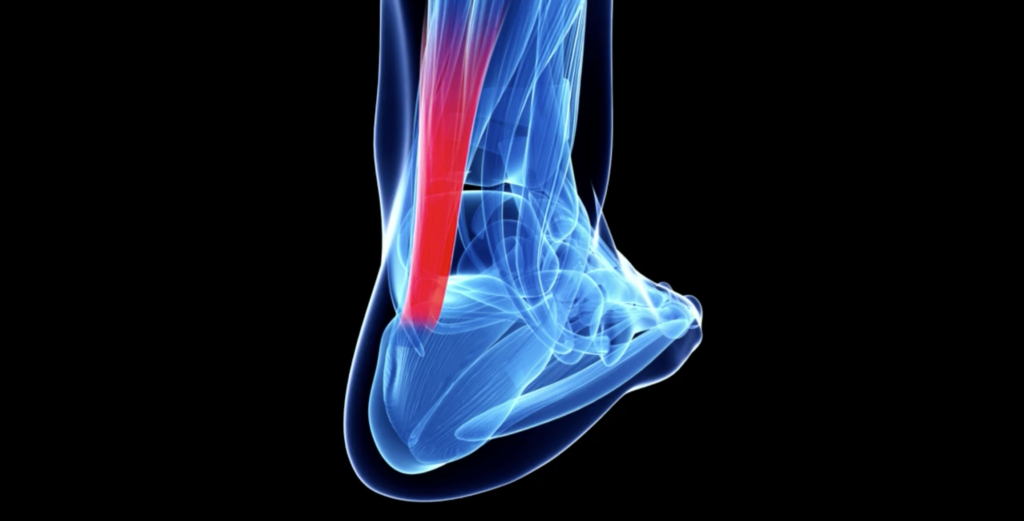treatment of the achilles tendon using regenerative medicine