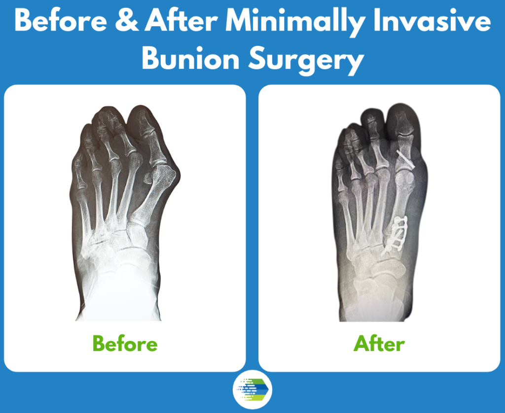 Before and after minimally invasive bunion surgery