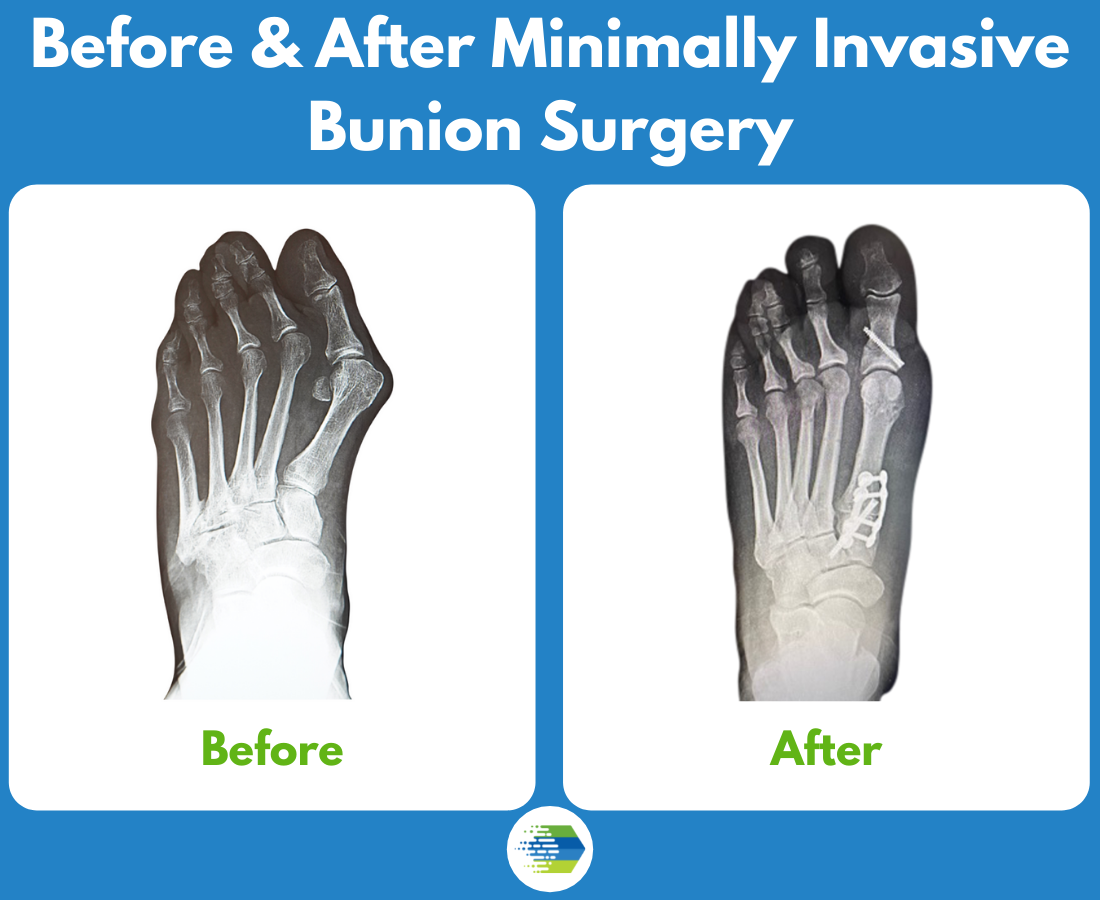 Minimally Invasive Bunion Surgery: What You Need To Know - The Frankel ...