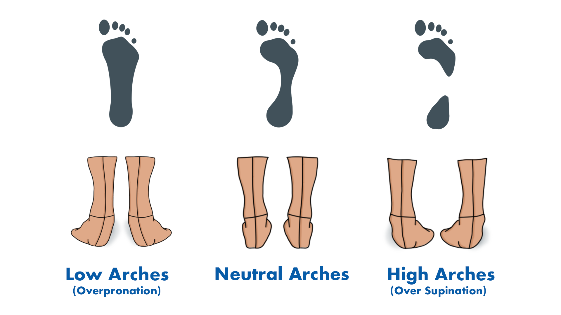 Foot arches infographic. Low arches, normal arches, and high arches
