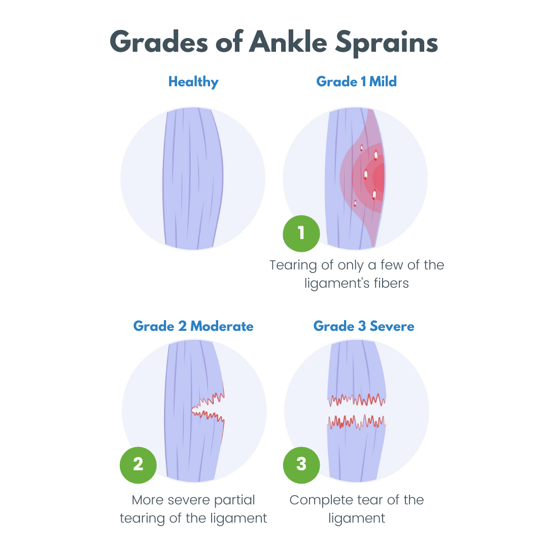 grade 1 ankle sprain swelling