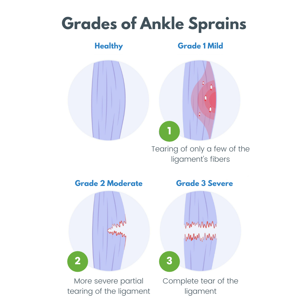 ankle sprain grades 1