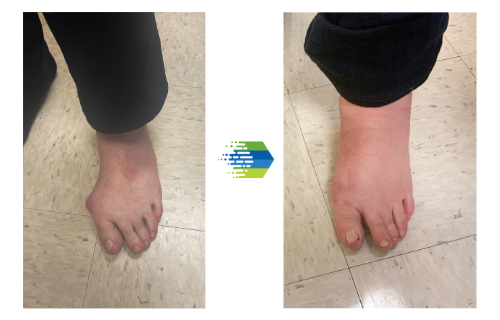 Complex Deformity Correction - The Frankel Foot & Ankle Center