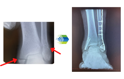 Ankle Fracture – Case 1 - The Frankel Foot & Ankle Center