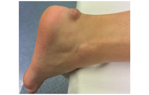 Preventing and Treating Haglund's Deformity with Compression Socks - Run  Forever Sports