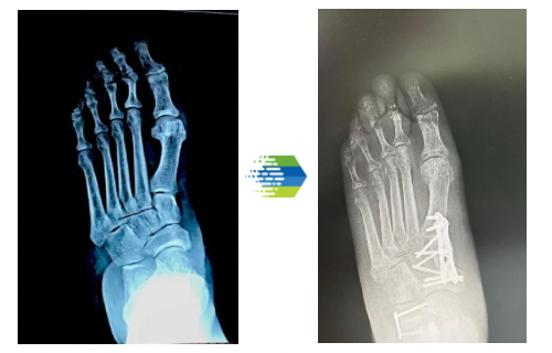 x-ray ankle before and after